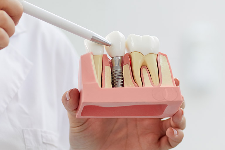 Clínica Dental Maestro. Un implante dental puede dar fin a los riesgos cardiovasculares provocados por la falta del diente