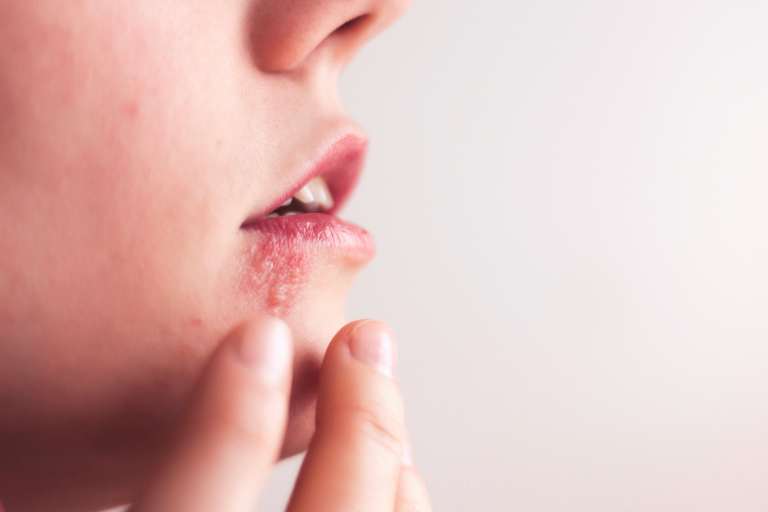 Causas, síntomas y tratamiento del herpes oral
