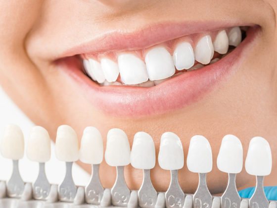 Cuánto dura un blanqueamiento dental