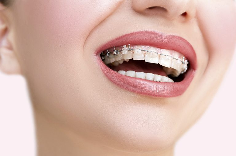 Clínica Dental Maestro. 5 Consejos para cuidar tu ortodoncia