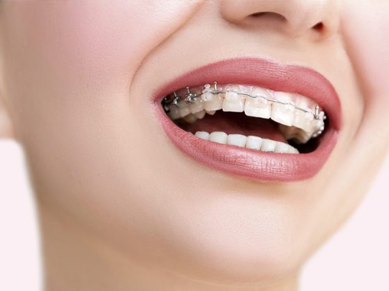 Clínica Dental Maestro. 5 Consejos para cuidar tu ortodoncia