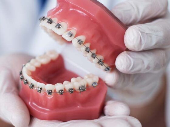 cuánto dura un tratamiento de ortodoncia. Ortodoncia en Oviedo. Clínica dental Maestro