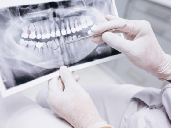 Implantes dentales con poco hueso. Implantes dentales en Oviedo