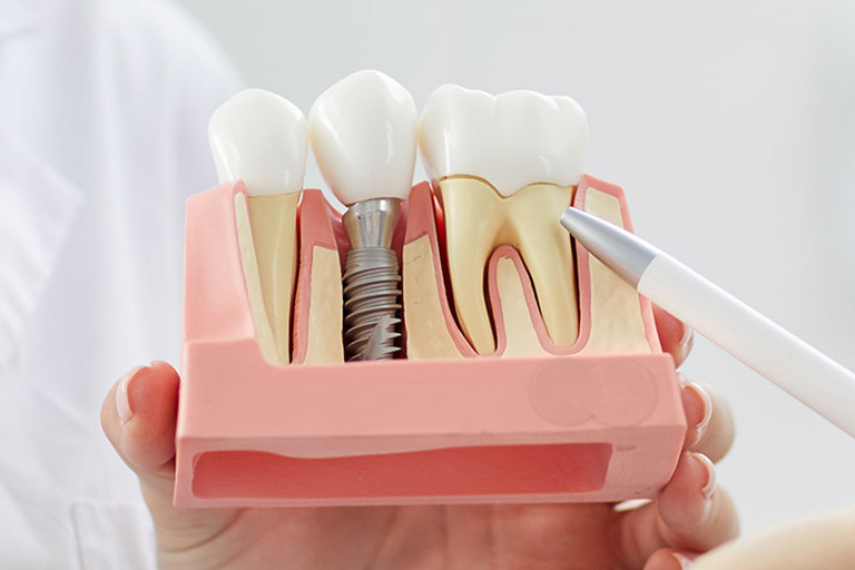 clinica dental maestro. Los implantes dentales son una solución definitiva para la perdida de dientes