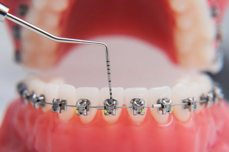 Dental Maestro. La ortodoncia para adultos cada vez es más popular