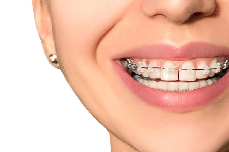 Consecuencias del diastema dental ▷ Clínica Dental Maestro