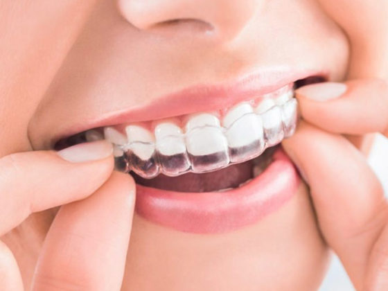 Clínica Dental Maestro. Ortodoncia Invisible Invisalign
