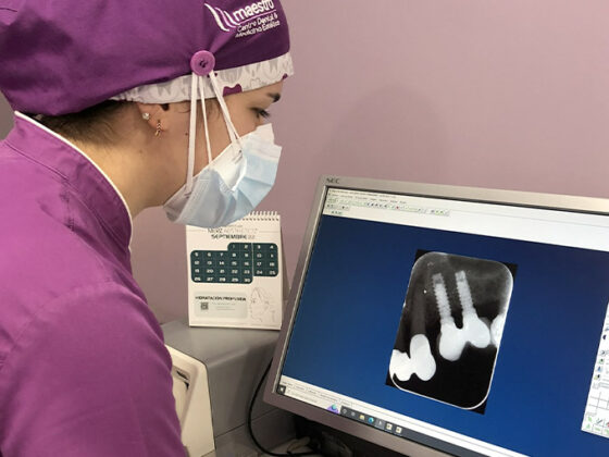 Implantes dentales baratos en Oviedo Maestro