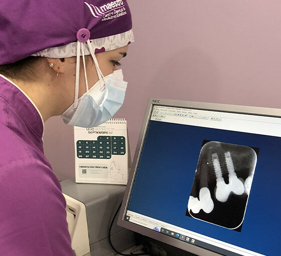Implantes dentales baratos en Oviedo Maestro