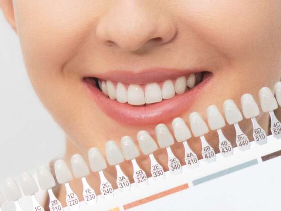 ¿Cuál es el mejor tratamiento para blanquear los dientes?