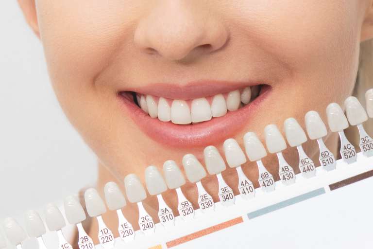 ¿Cuál es el mejor tratamiento para blanquear los dientes?