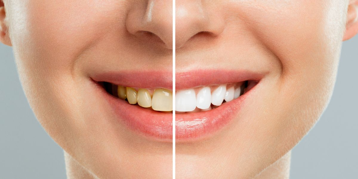 Blanqueamiento dental con Phillips Zoom - Clínica Dental Maestro - Dentista en Oviedo