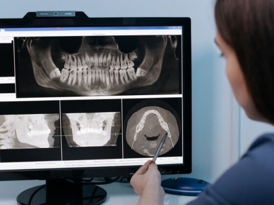 Cuidados postoperatorios de implantes dentales implantes dentales en Oviedo