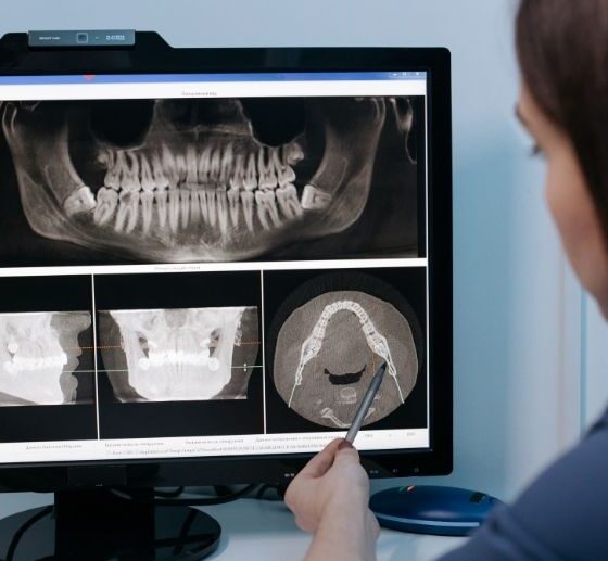 Cuidados postoperatorios de implantes dentales implantes dentales en Oviedo
