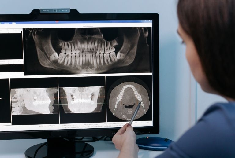 Cuidados postoperatorios de implantes dentales implantes dentales en Oviedo